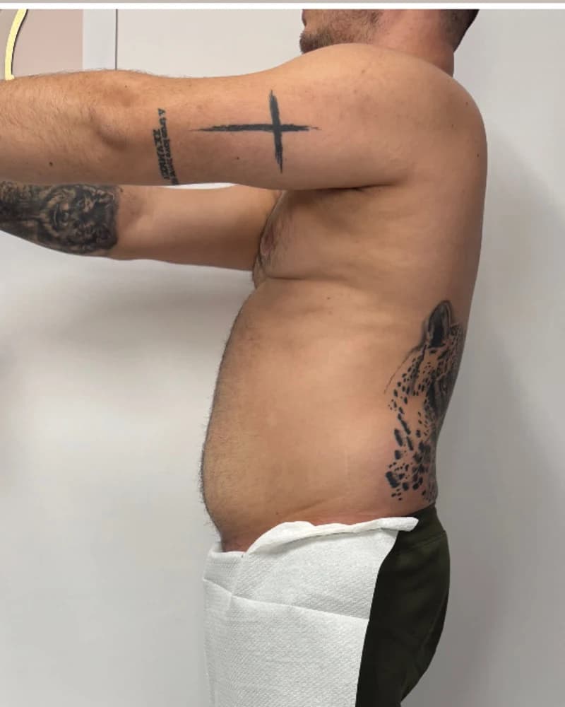 Liposonix - abdomen inferior - după