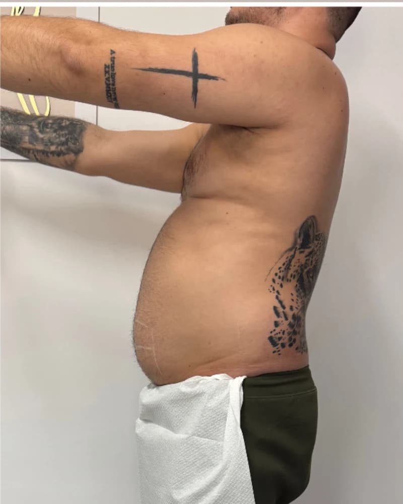 Liposonix - abdomen inferior - înainte
