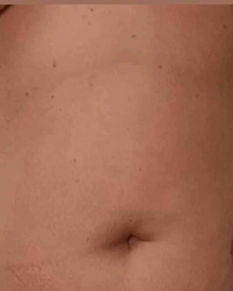 Cavitație - abdomen - după