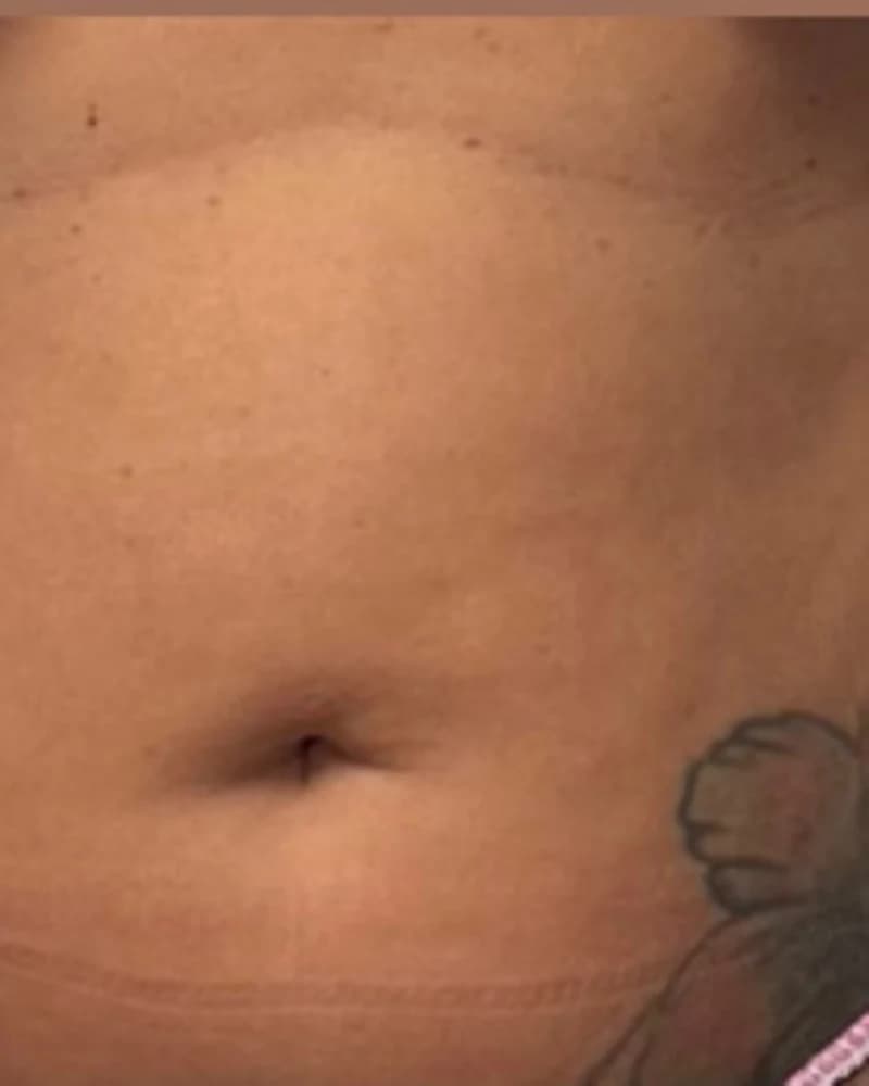 Cavitație - abdomen - înainte