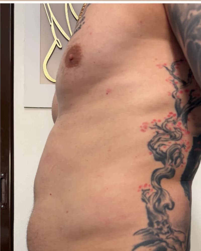 Cavitație și vacuum - abdomen - înainte