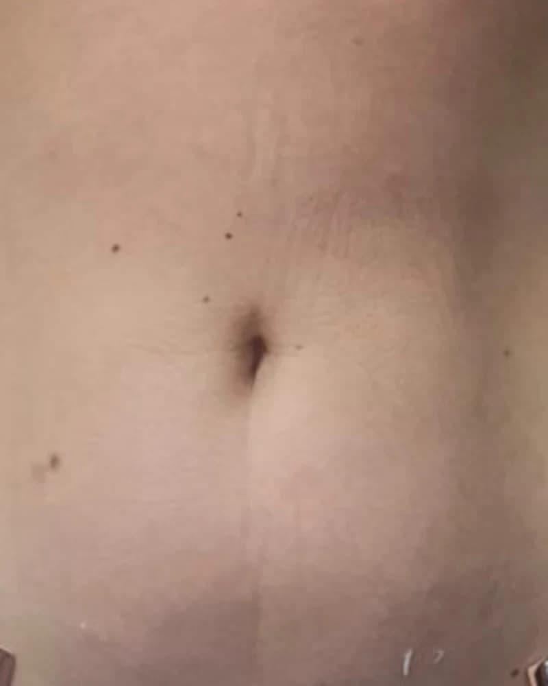 Liposonix - abdomen - după