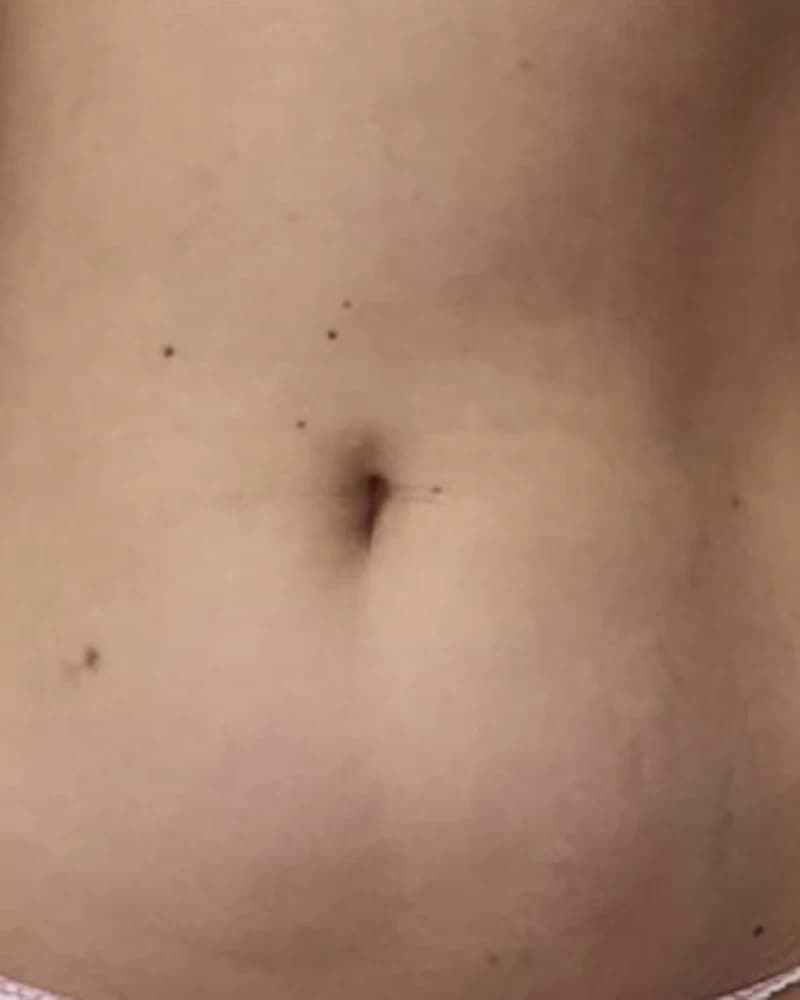 Liposonix - abdomen - înainte