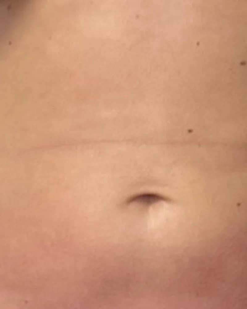 Liposonix - abdomen inferior și flancuri - după
