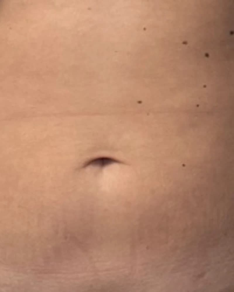Liposonix - abdomen inferior și flancuri - înainte